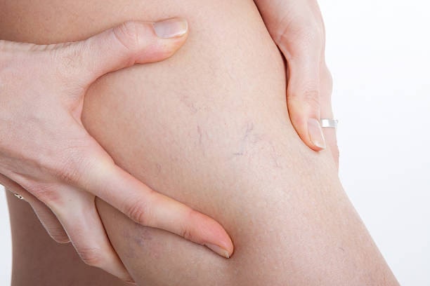 Odyssey Vein Clinic varicose vein removal Adelaide