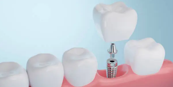 dental implants Adelaide